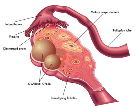 Ovarian Cyst Symptoms How They Develop How To Treat Them University Health News