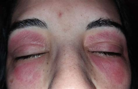Eyelid Dermatitis Causes Symptoms Diagnosis Treatment