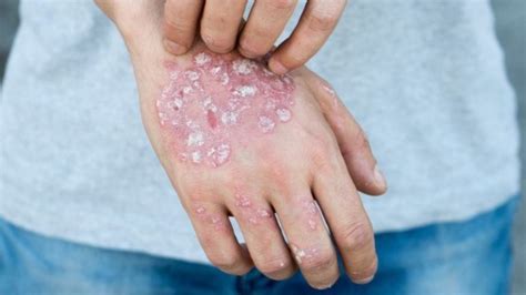 Fungal Infections Of The Skin Different Fungi