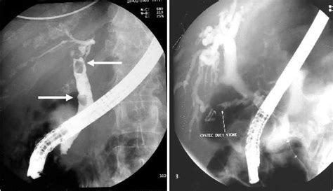 Investigations Gallstones