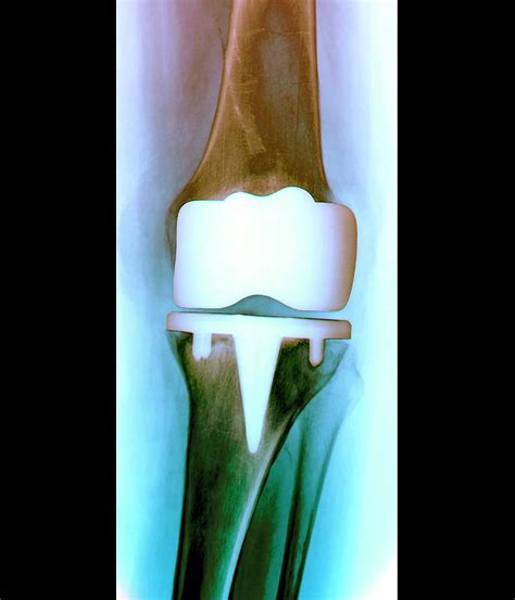 Prosthetic Knee Joint Photograph By Zephyrscience Photo Library Fine