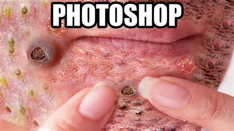 Dr Neak S Blackheads Pimples Zits And Bizarre Photoshop YouTube