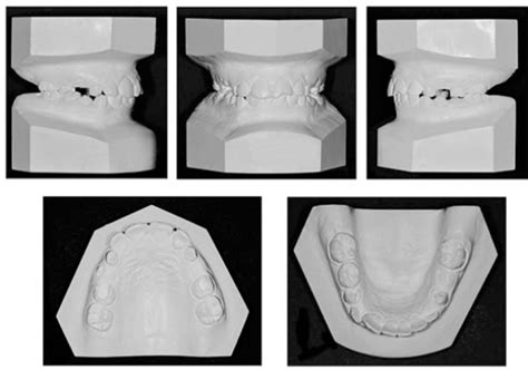 Fig Pretreatment Dental Casts Photographs