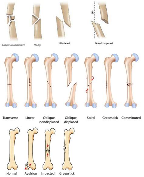 Bone Fractures Anatomy Worksheet Anatomy Worksheets