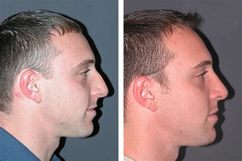 Show photos of noses you admire to make sure that you are both on the same page. Male Rhinoplasty Photos | Male Nose Job Patient Photos