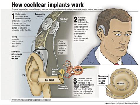 Cochlear Implants Give The T Of Hearing But Theyre Not For