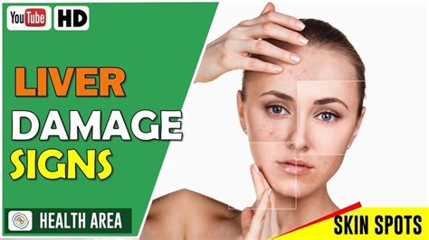6 Early Symptoms Of Liver Damage Dont Ignore These Skin Spots Liver