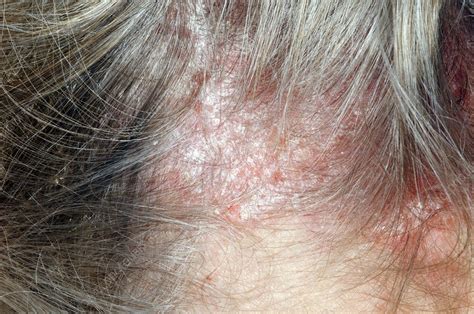 Psoriasis On The Scalp Stock Image C0169280 Science Photo Library