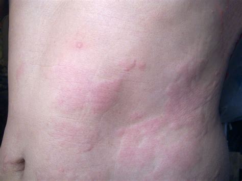Hives Due To Heat Or Exercise Cholinergic Urticaria