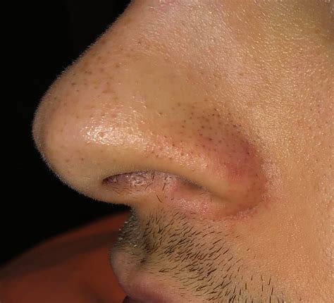 Skin Concerns Post Pimple Redness On Nose Not Going Away