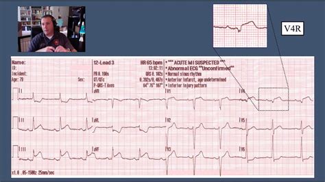 Abnormal 12 Lead Ecg