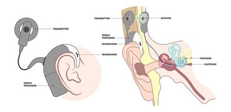What Is A Cochlear Implant And When Do You Need One