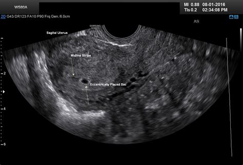 4 Week Vaginal Ultrasound Pictures