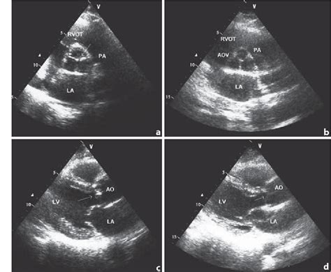 Figure 1 From Relationship Between Aortic Valve Sclerosis And The