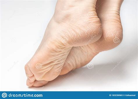 Womans Feet Dry And Cracked Soles Of Feet On White Background Stock