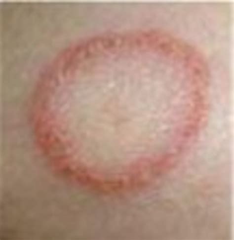 Ringworm Treatment Your Free Guide To Real Help Hubpages