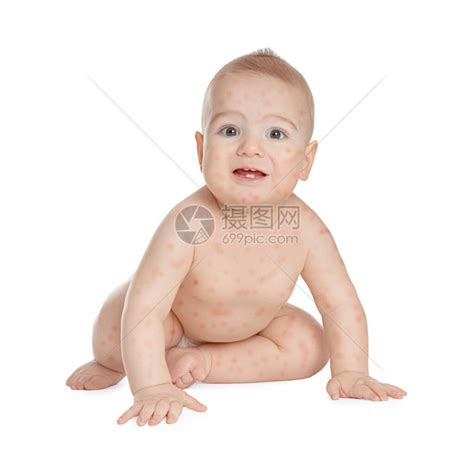 白色背景上有红色皮疹的小孩婴儿过敏高清图片下载 正版图片506560662 摄图网