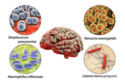 Causes Of Bacterial Meningitis Photograph By Kateryna Konscience Photo