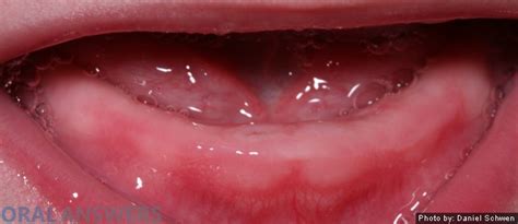 What A Babys Gums Look Like While Teething Oral Answers