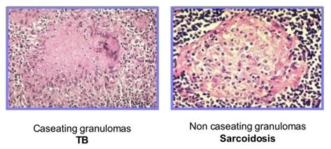 Difference Between Sarcoidosis And Tuberculosis Epomedicine