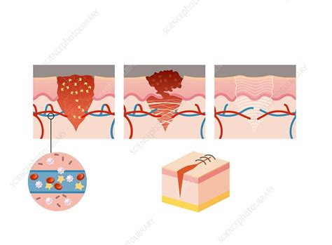 Wound Healing Illustration Stock Image C0424373 Science Photo