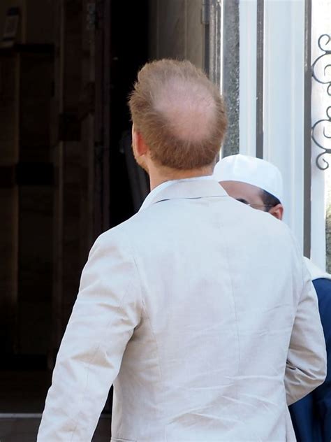 Prince Harrys Bald Patch Doubles In Size After Marrying Meghan Triple Uk