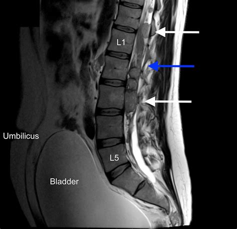 Combined Intramedullary And Intradural Extramedullary Spinal Metastases