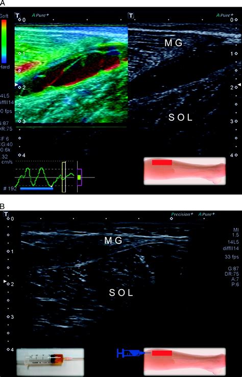 A Novel Application Of Strain Ultrasound Elastography In The American Journal Of Physical