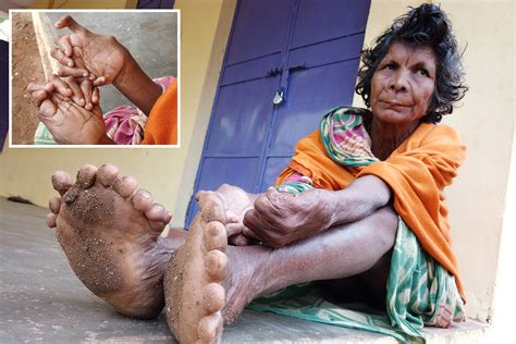 woman with thirty one fingers and toes sets new guinness world record for having most digits