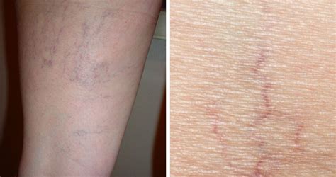 Causes Of Spider Veins Vein Solutions