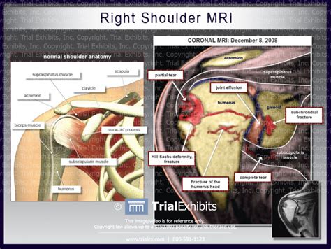 Right Shoulder Mri Trialexhibits Inc