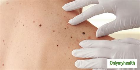Mole Or Melanoma How To Tell If It Is Just A Mole Or An Underlying Skin Cancer Onlymyhealth