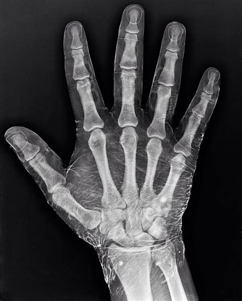 X Ray Of An Iodine Dipped Hand Anatomy For Artists X Ray Hand Anatomy