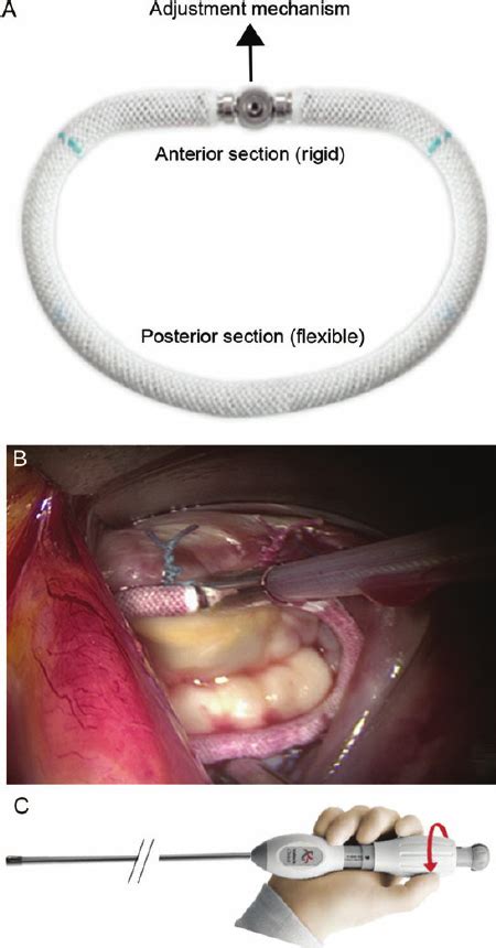 Prallen Auszahlen Sich Versichern Annuloplasty Ring Wählen Aktuator Paket