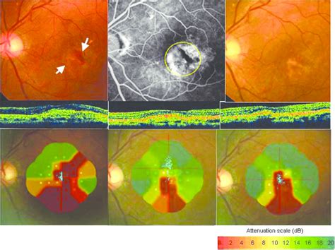 Fundus Photographs Fluorescein Angiograms Optical Coherence