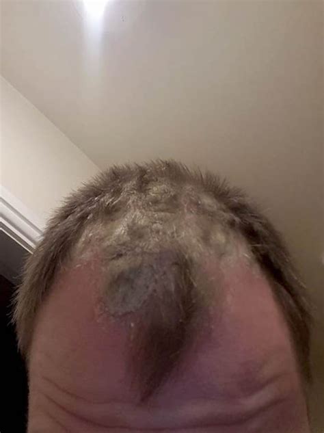Could Hair Wax Cause Baldness Man Claims Product Made Hair Fall Out