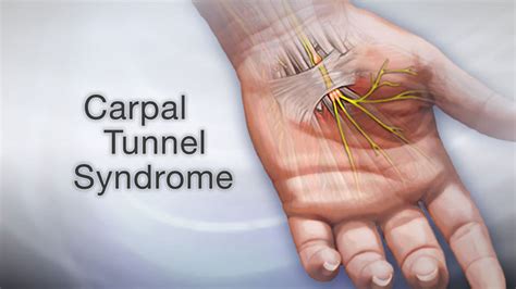 3 Treatments For Carpal Tunnel Syndrome And How Chiropractors Can Help