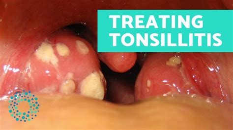 How To Treat Tonsillitis Naturally Youtube