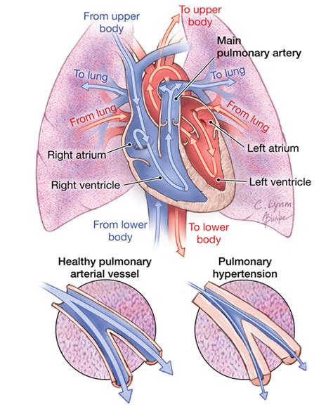 Pulmonary Hypertension Pulmonary Medicine Jama Jama Network