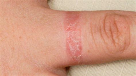 Allergic Contact Dermatitis Nickel