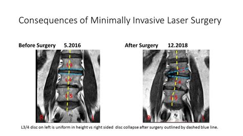 Consequences Of Minimally Invasive Spine Surgery
