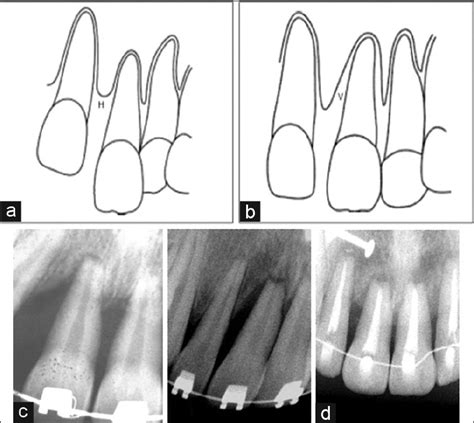 A Severe Bone Loss Spacing And Extrusion Of Incisors Horizontal Download Scientific Diagram