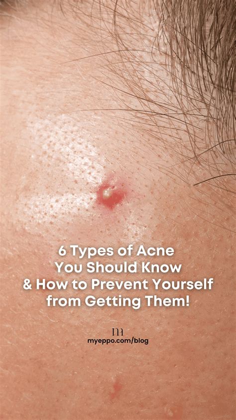 6 Types Of Acne You Should Know And How To Prevent Yourself From Getting Them Myeppo