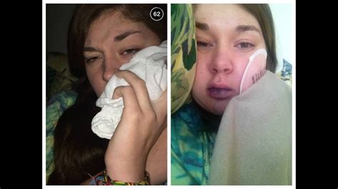 Wisdom Teeth Before And After