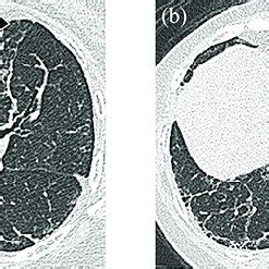 Axial High Resolution Chest Computed Tomography Image In November 2015