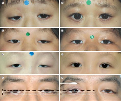Positional Change Of Lower Eyelid After Surgical Correction Of