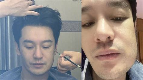 Huang Xiaoming Shows How Square His Jawline Is After Wisdom Tooth