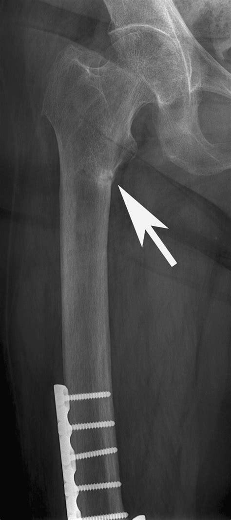 Imaging Of Insufficiency Fractures European Journal Of Radiology