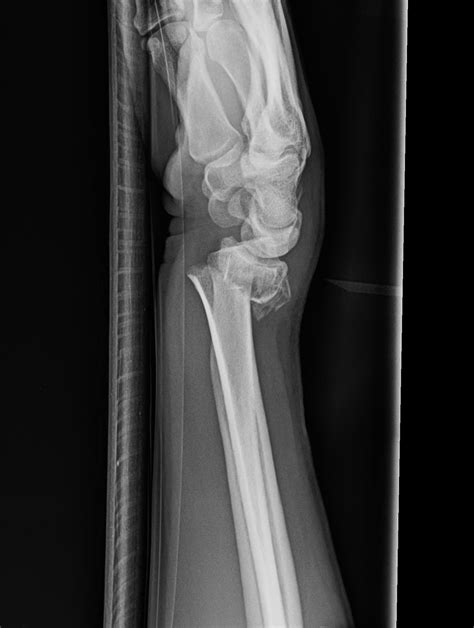 Broken Wrist Treatment In Raleigh Nc John Erickson Md