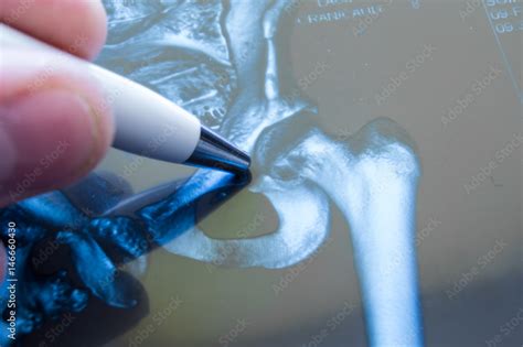 X Ray Of Hip Joint Doctor Pointed On Area Of Hip Joint Where